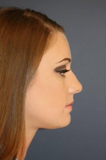 Before image 3 Case #126241 - Female Rhinoplasty