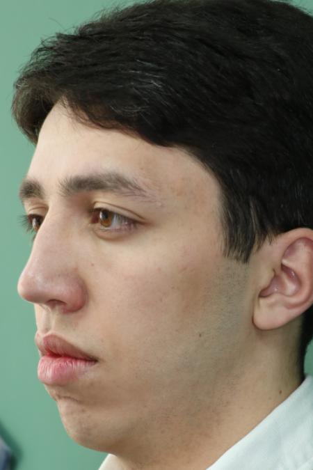 After image 3 Case #126756 - Nasal Deviation Syndrome