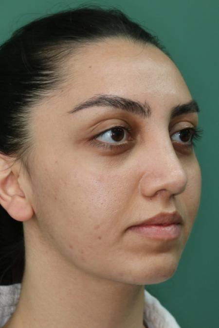 After image 3 Case #126796 - Nasal Deviation Syndrome. Rhinogenic Headache 