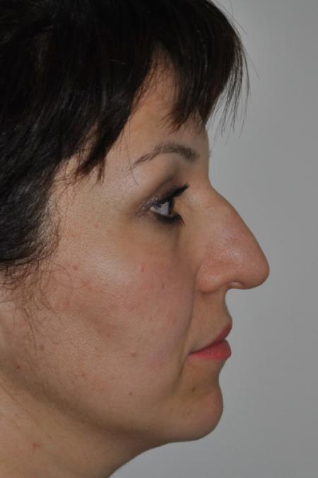 Before image 4 Case #126781 - Aesthetic Reduction Rhinoplasty