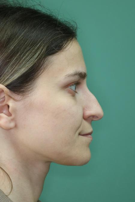 Before image 5 Case #122911 - Primary Septorhinoplasty