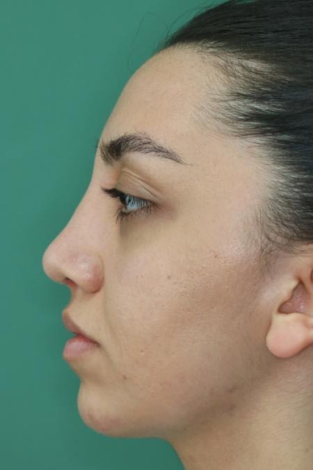 After image 5 Case #126796 - Nasal Deviation Syndrome. Rhinogenic Headache 