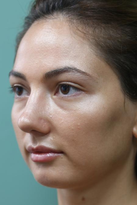 After image 3 Case #126811 - Reduction Rhinoplasty