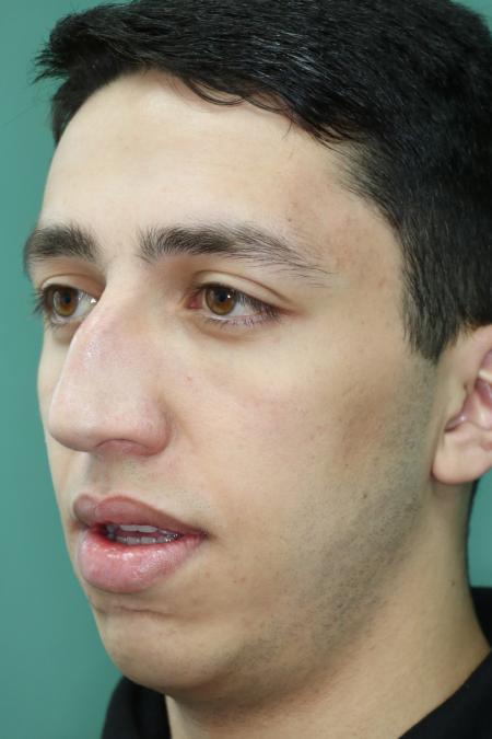 Before image 3 Case #126756 - Nasal Deviation Syndrome