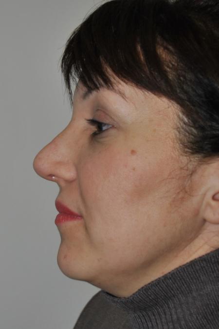 After image 5 Case #126781 - Aesthetic Reduction Rhinoplasty
