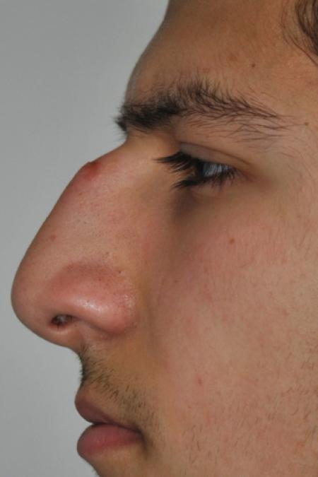Before image 5 Case #126761 - Primary Rhinoplasty