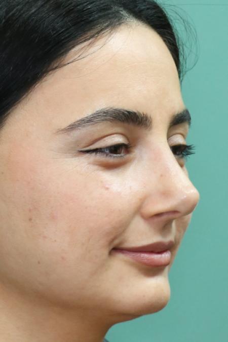 After image 2 Case #122581 - Primary Rhinoplasty