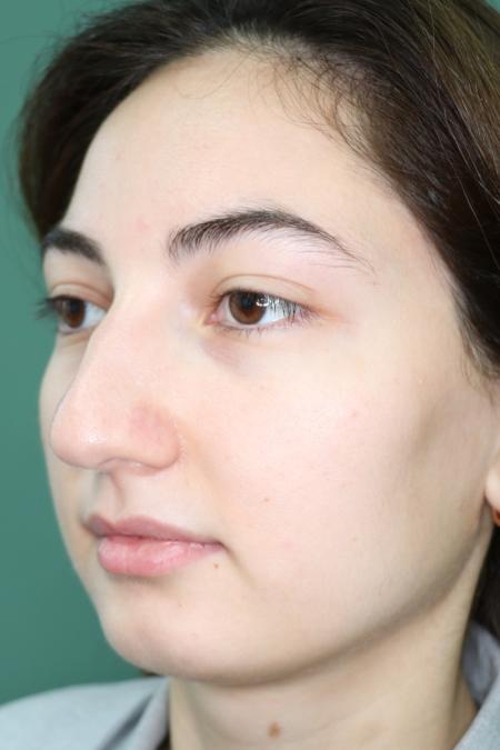 Before image 3 Case #126811 - Reduction Rhinoplasty