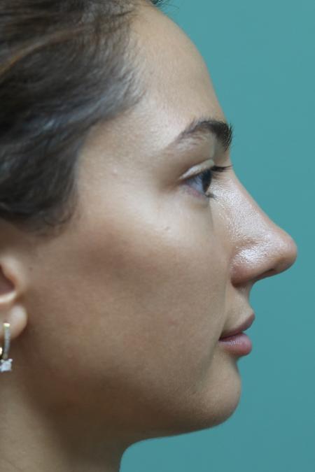 After image 5 Case #126811 - Reduction Rhinoplasty