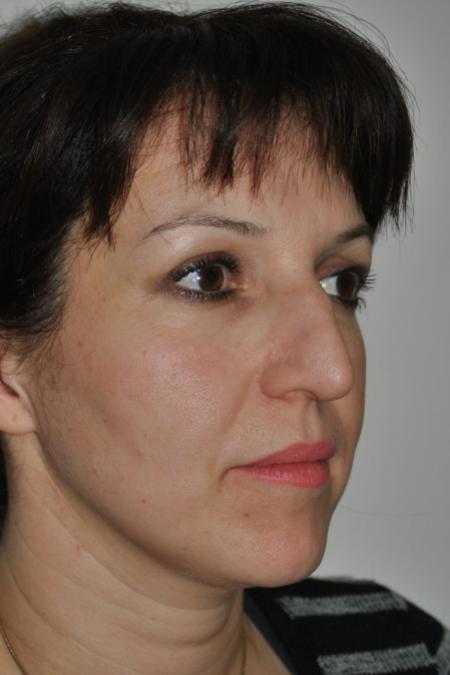 Before image 2 Case #126781 - Aesthetic Reduction Rhinoplasty