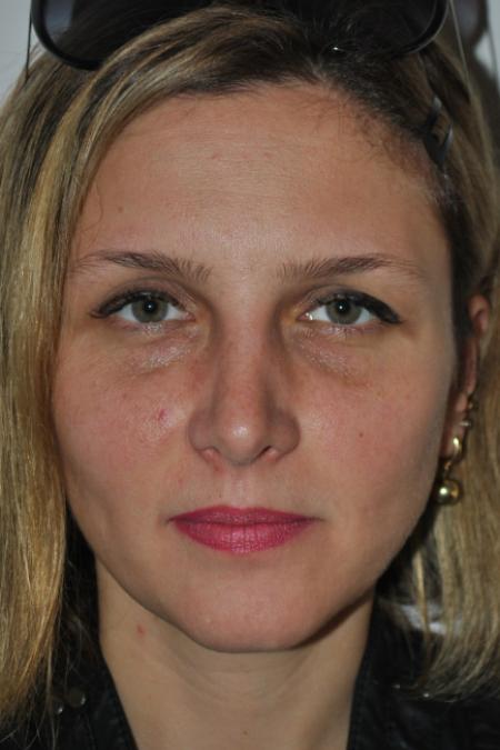 After image 1 Case #126766 - Nasal Deviation Syndrome