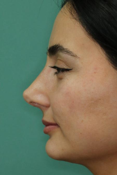 After image 5 Case #122581 - Primary Rhinoplasty