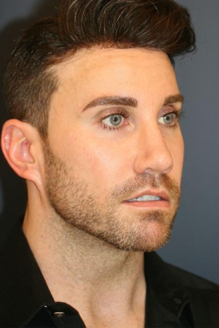 After image 2 Case #126816 - Male Rhinoplasty