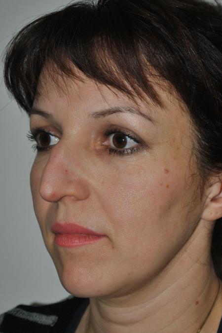 Before image 3 Case #126781 - Aesthetic Reduction Rhinoplasty