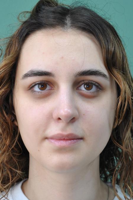 After image 1 Case #122886 - Functional Aesthetic Septorhinoplasty