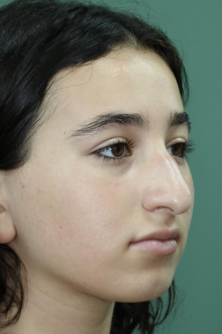 Before image 2 Case #126786 - Nasal Deviation Syndrome