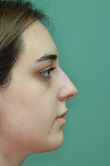 Before image 4 Case #122886 - Functional Aesthetic Septorhinoplasty