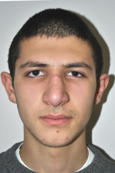 After image 1 Case #126761 - Primary Rhinoplasty