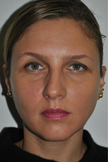 Before image 1 Case #126766 - Nasal Deviation Syndrome