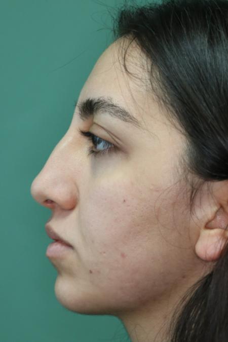 Before image 5 Case #126796 - Nasal Deviation Syndrome. Rhinogenic Headache 