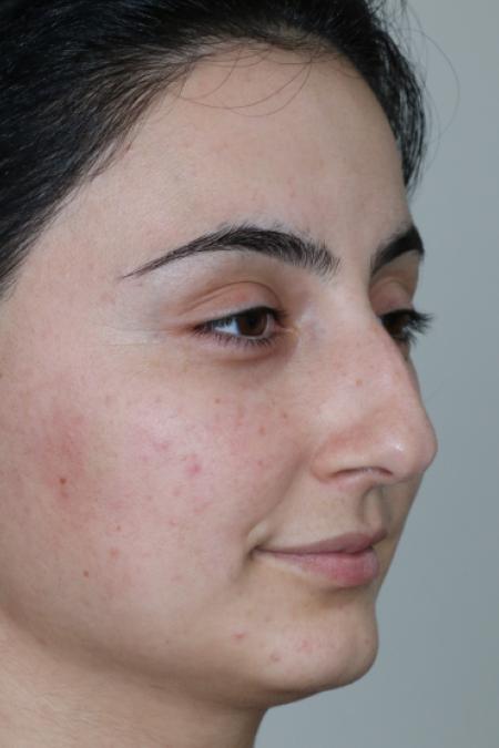 Before image 2 Case #122581 - Primary Rhinoplasty