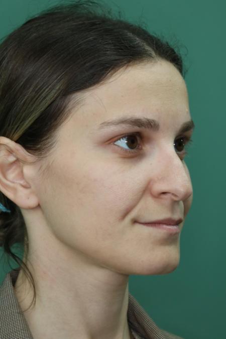 Before image 3 Case #122911 - Primary Septorhinoplasty
