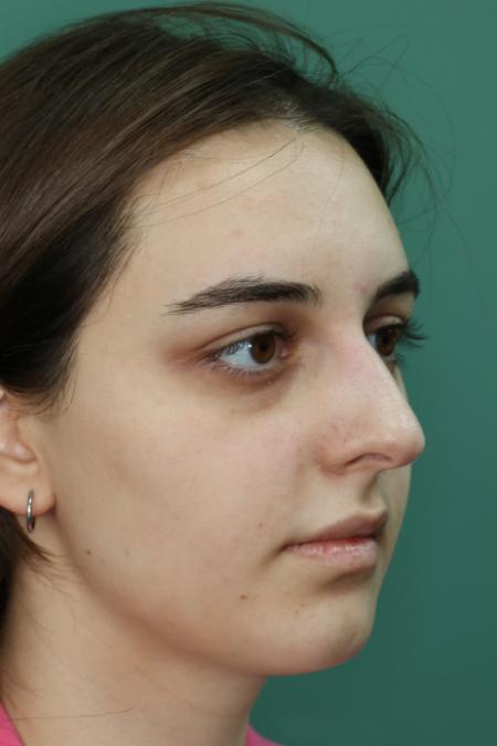 Before image 3 Case #122886 - Functional Aesthetic Septorhinoplasty