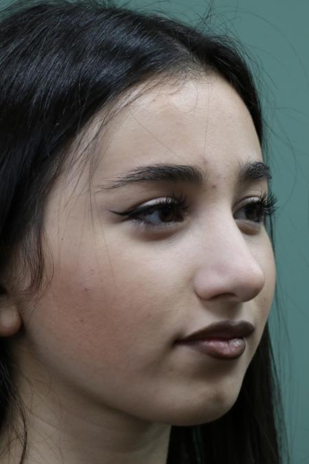 After image 2 Case #126786 - Nasal Deviation Syndrome