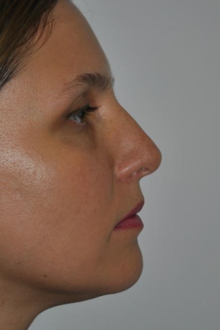 Before image 4 Case #126766 - Nasal Deviation Syndrome