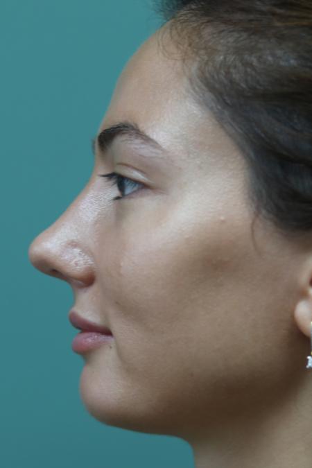 After image 4 Case #126811 - Reduction Rhinoplasty