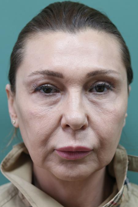 Before image 1 Case #122891 - Upper Lid Open Sky Blepharoplasty, Midface Lifting