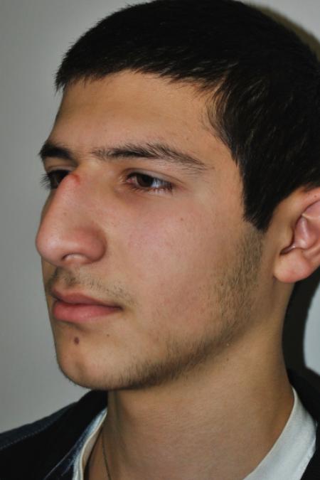 Before image 3 Case #126761 - Primary Rhinoplasty