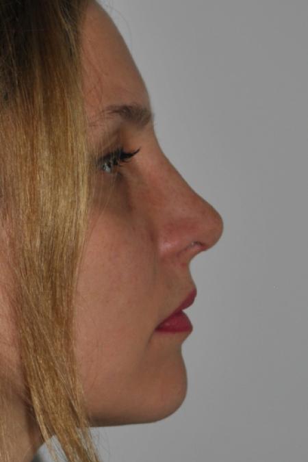 After image 4 Case #126766 - Nasal Deviation Syndrome