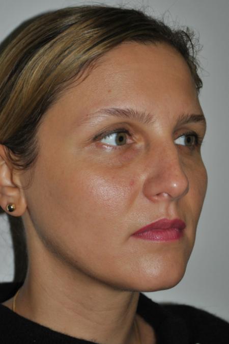 Before image 3 Case #126766 - Nasal Deviation Syndrome