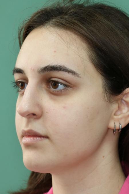 Before image 2 Case #122886 - Functional Aesthetic Septorhinoplasty