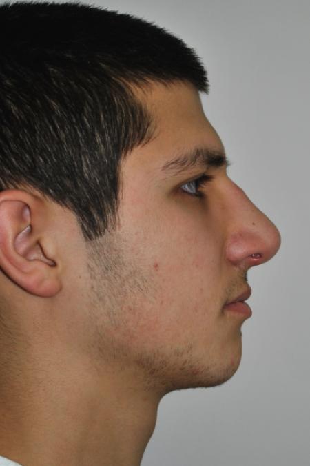After image 4 Case #126761 - Primary Rhinoplasty