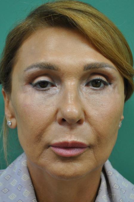 After image 1 Case #122891 - Upper Lid Open Sky Blepharoplasty, Midface Lifting