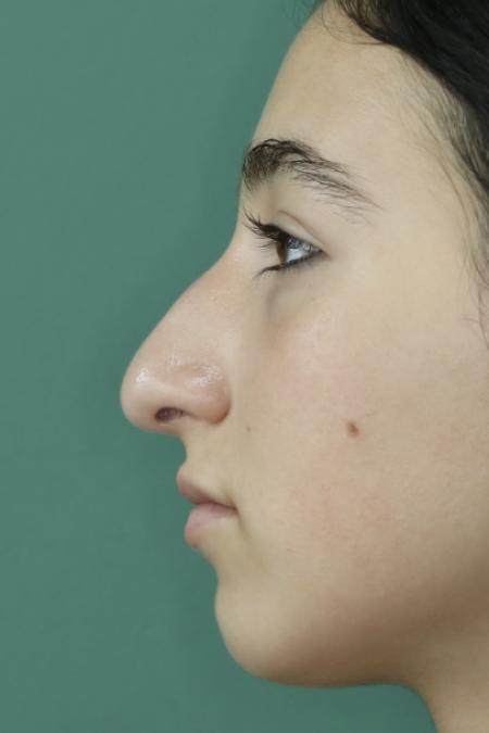 Before image 5 Case #126786 - Nasal Deviation Syndrome