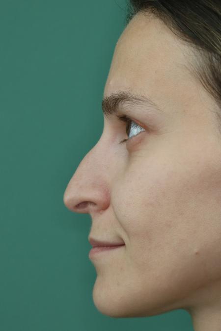 Before image 4 Case #122911 - Primary Septorhinoplasty