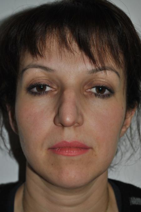 Before image 1 Case #126781 - Aesthetic Reduction Rhinoplasty