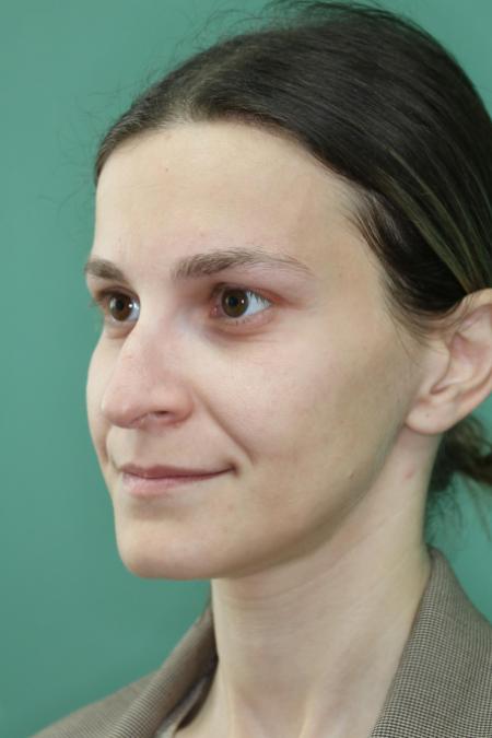 Before image 2 Case #122911 - Primary Septorhinoplasty