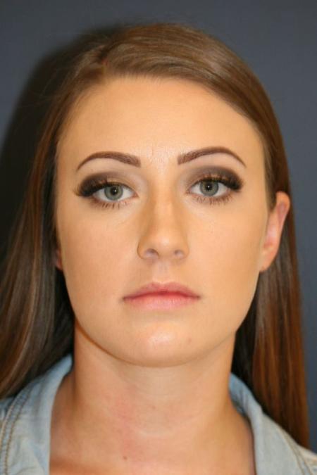 Before image 1 Case #126241 - Female Rhinoplasty