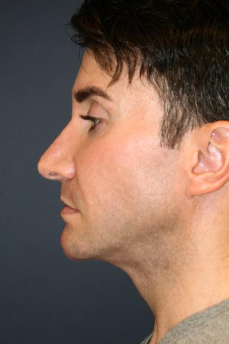 Before image 3 Case #126816 - Male Rhinoplasty