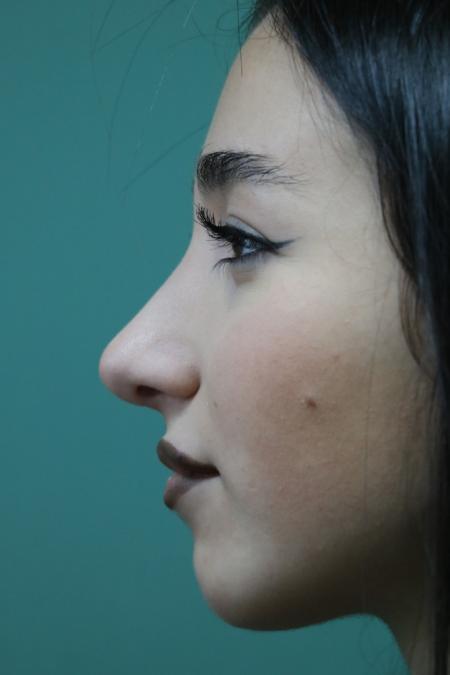 After image 5 Case #126786 - Nasal Deviation Syndrome