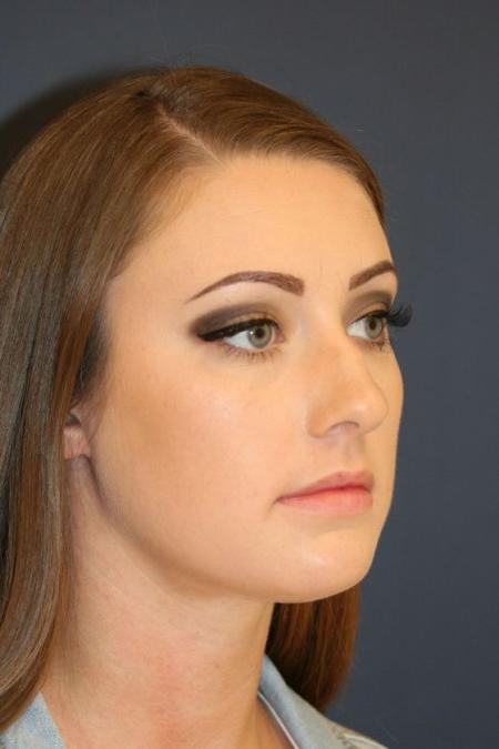 Before image 2 Case #126241 - Female Rhinoplasty