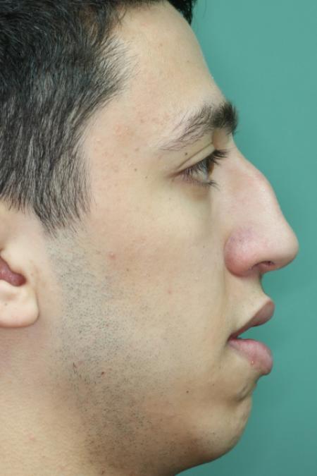 Before image 4 Case #126756 - Nasal Deviation Syndrome