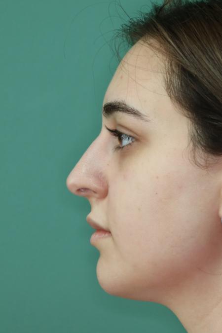 Before image 5 Case #122886 - Functional Aesthetic Septorhinoplasty