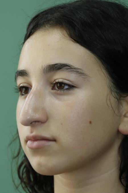 Before image 3 Case #126786 - Nasal Deviation Syndrome