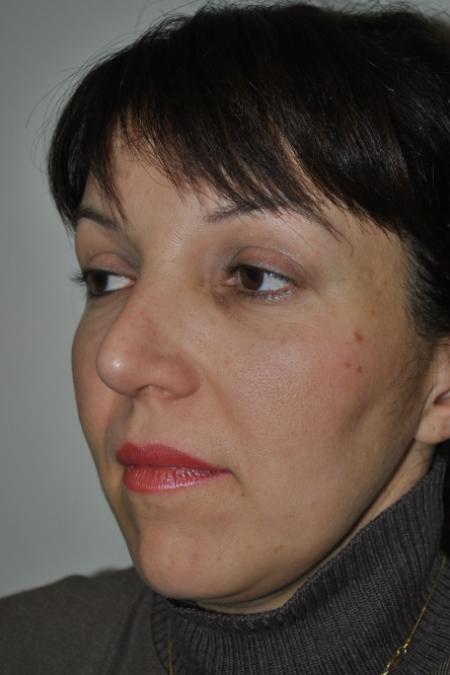 After image 3 Case #126781 - Aesthetic Reduction Rhinoplasty