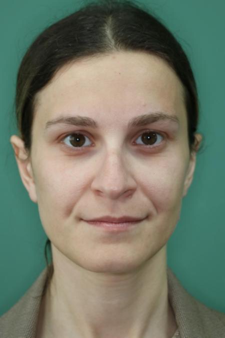 Before image 1 Case #122911 - Primary Septorhinoplasty